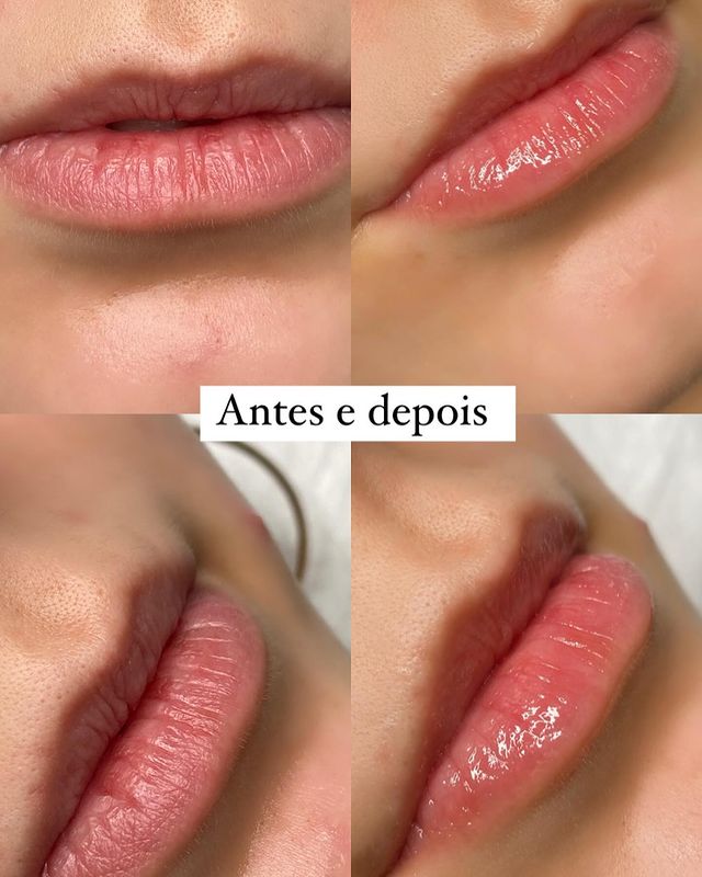 Lábios antes e depois do Hydra gloss